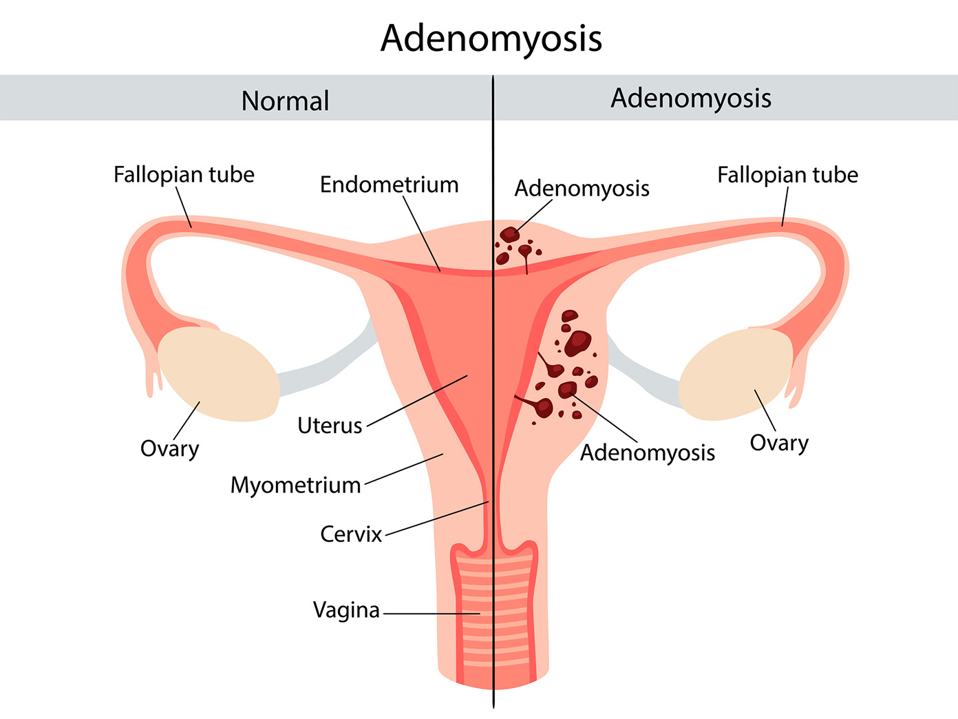 adenomyos
