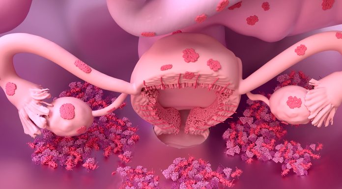 endometrios