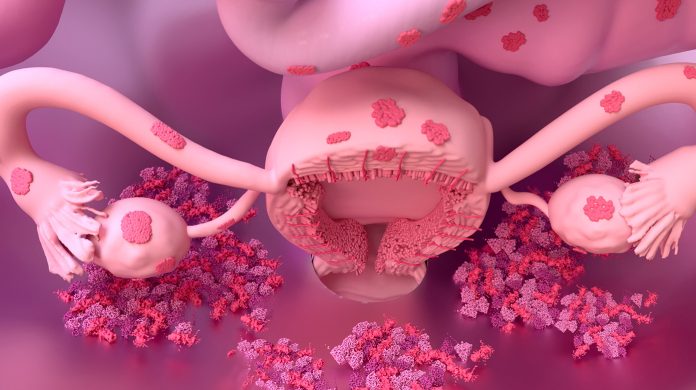 endometrios